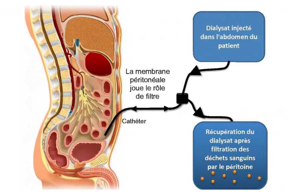 La dialyse péritonéale