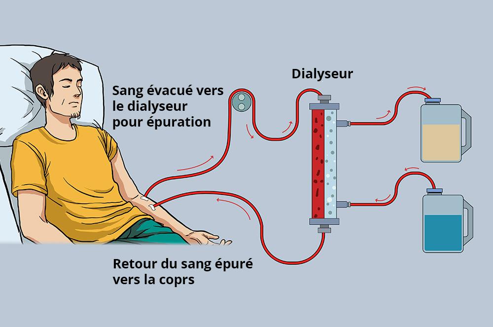 Hémodialyse